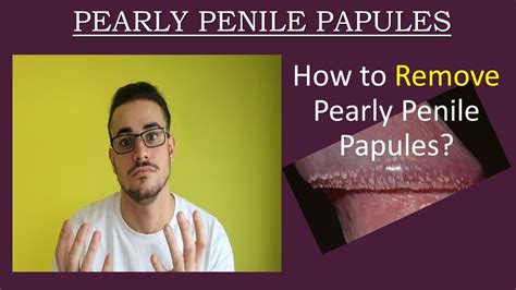 Pearly Penile Papules: White Spots on Penis